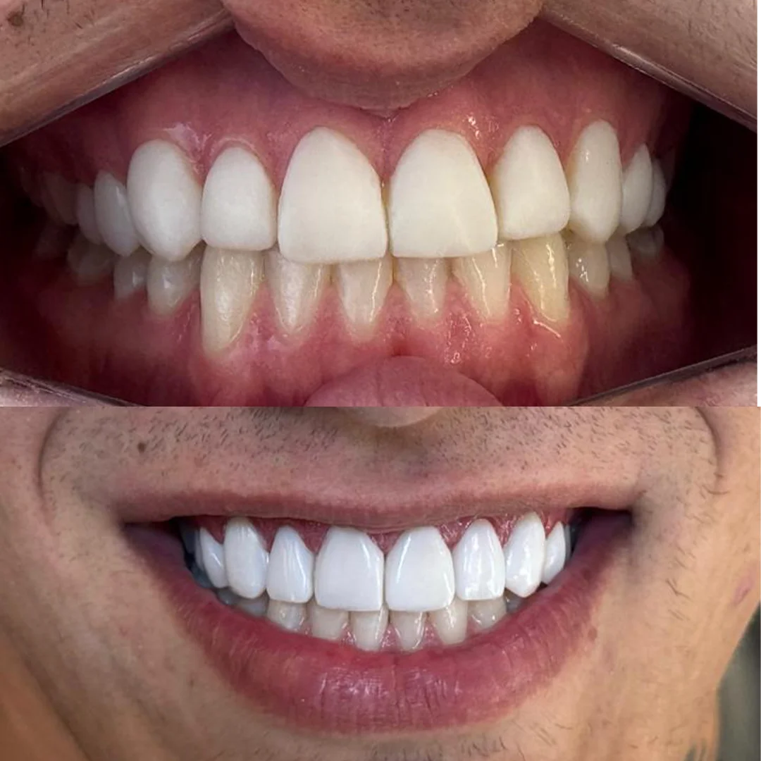 antes e depois 1