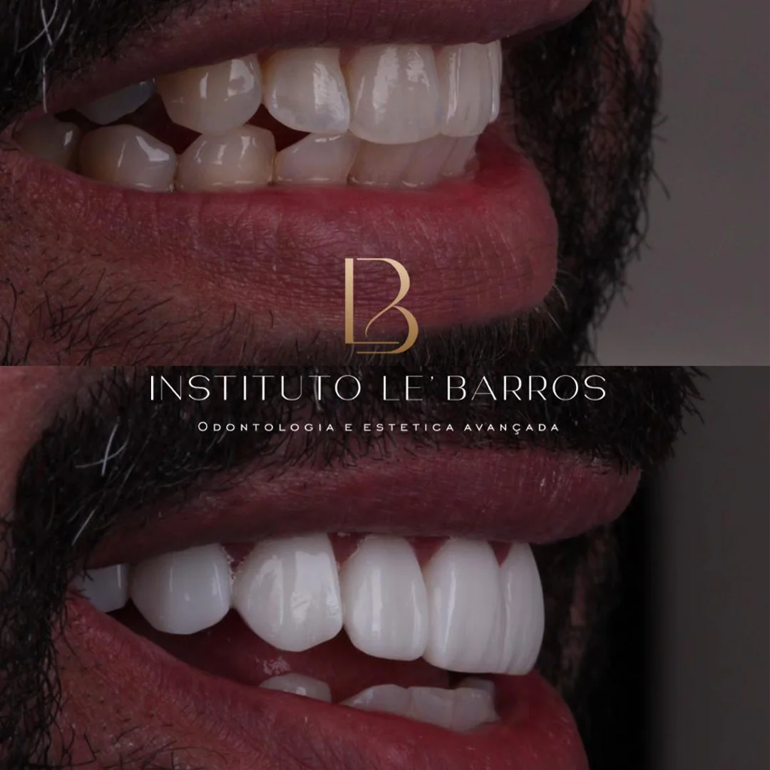antes e depois 2